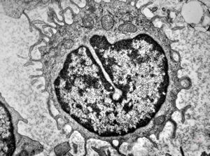 M,33y. | blood - hairy cell leukemia M,33y. | blood - hairy cell leukemia